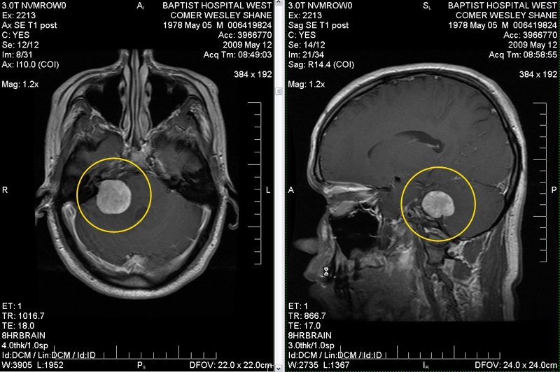 Brain-Tumor-2
