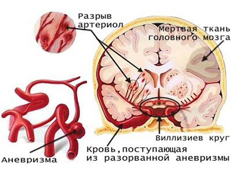 Спазм сосудов головного мозга: лечение и профилактика