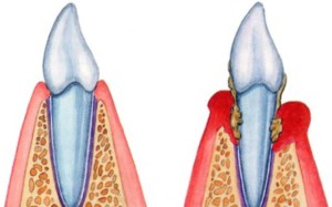 parodontitis1