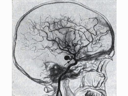Ангиограмма сосудов головного мозга