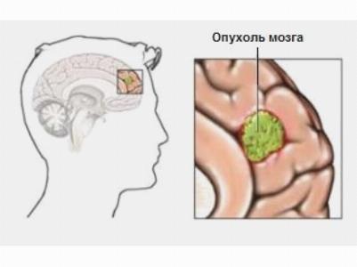 Астроцитома является опухолью головного мозга