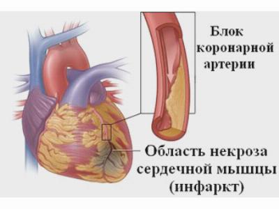 Из-за чего происходит инфаркт миокарда