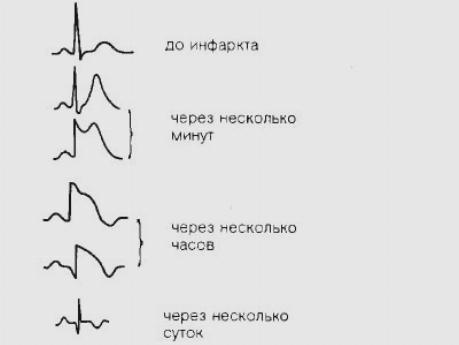 Кардиограмма сердца при инфаркте