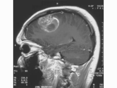 МТР головного мозга, для поиска опухоли