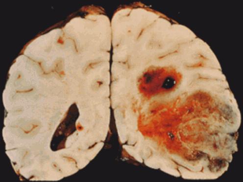Опухоли головного мозга: симптомы