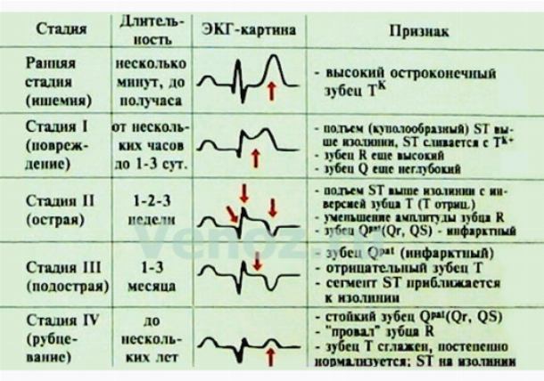Расшифровка показаний электрокардиограммы (ЭКГ) при болезнях сердца