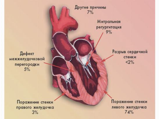 Роль различных механизмов, ответственных за развитие кардиогенного шока